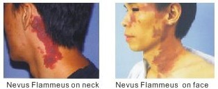 Treatment illustration